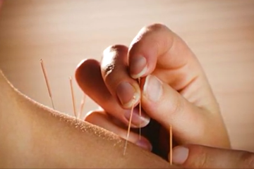 Dry Needling