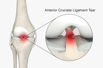 Anterior Cruciate Ligament (ACL)