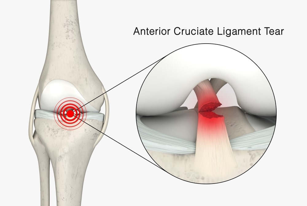 Anterior Cruciate Ligament (ACL)