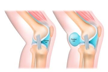 Baker's Cyst