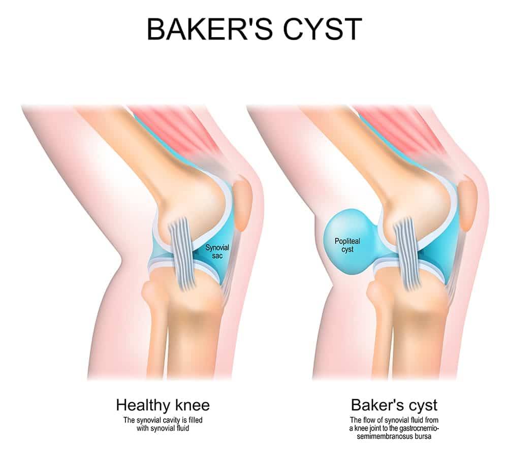 Baker’s Cyst Baker's Cyst