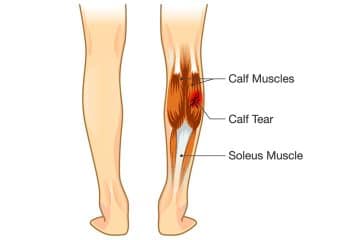 Calf Tear