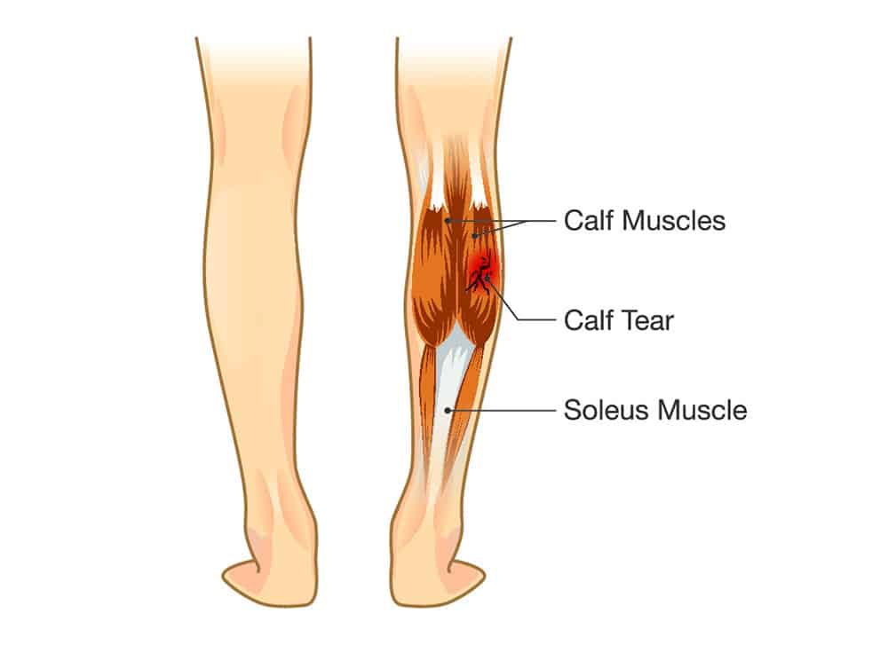 Calf Tear