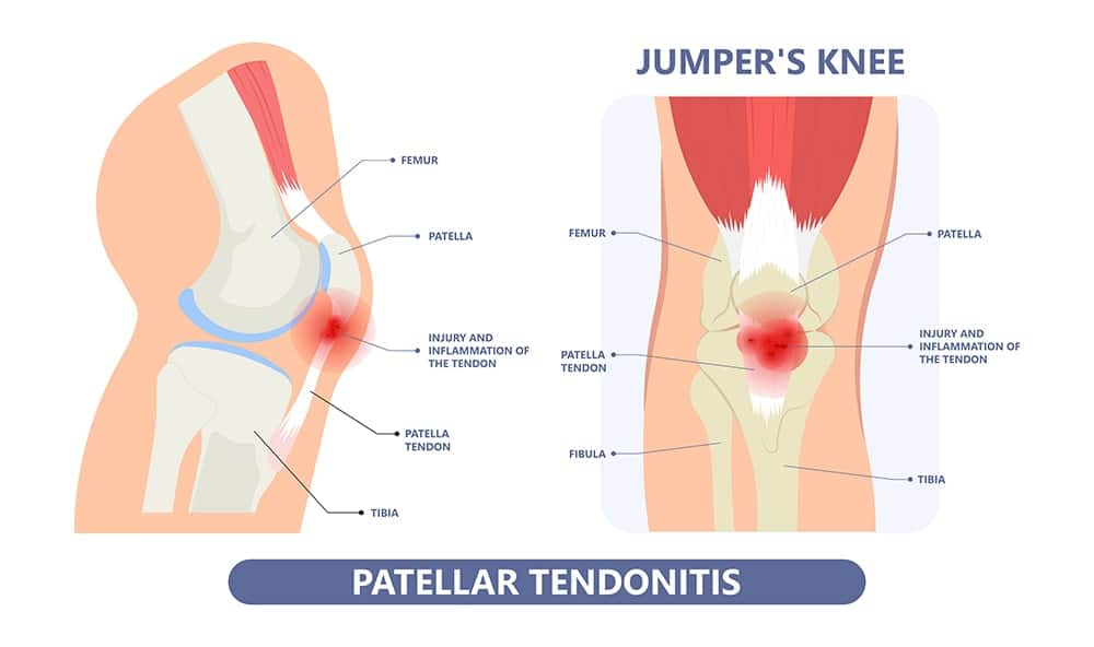 patellar tendonitis