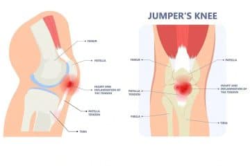 Patellar Tendonitis