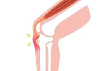 Osgood Schlatter Disease