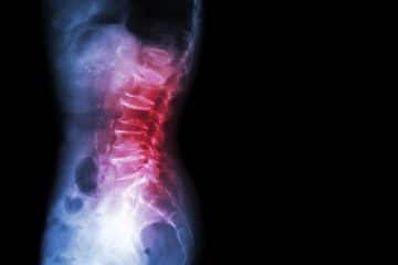 Spondylolisthesis