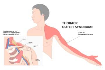 Thoracic Outlet Syndrome