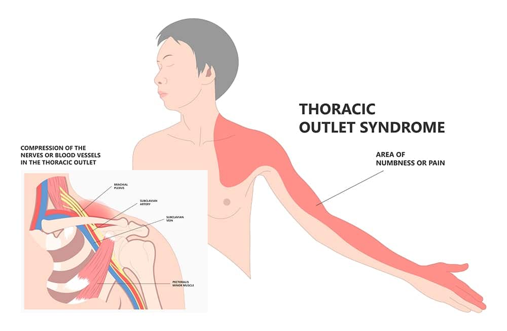 Thoracic Outlet Syndrome | My Physio My Health