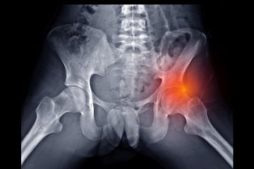 Femoroacetabular Impingement