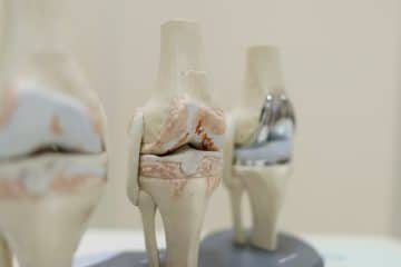 Total Knee Replacement